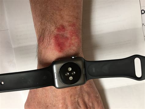 wrist irritation from apple watch